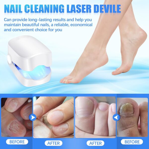 Rechargeable Nail Fungus Treatment for Toenail, Toe Nail Fungal Treatment Nail Fungus Laser Device, Anti-Fungal Nail Treatment for Hand & Feet Infections Remover for Home Use - Image 5