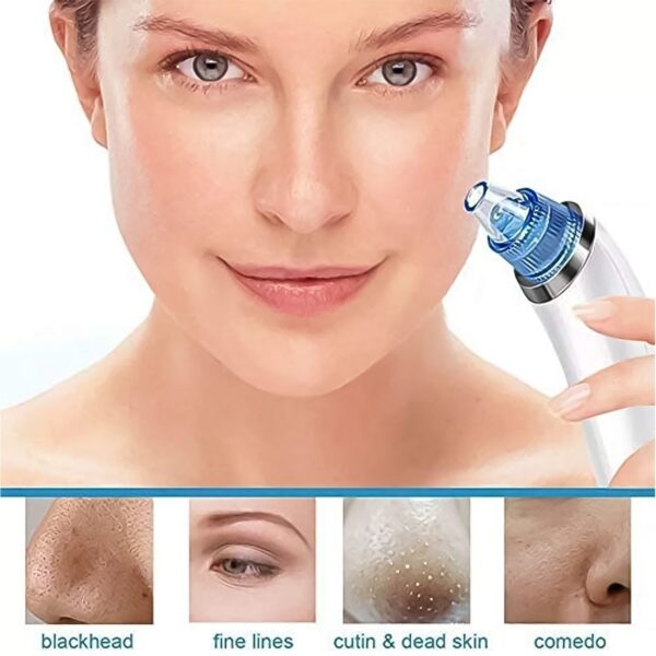 2 in 1 Blackhead Whitehead Extractor Remover Device (Multi-Color / 1 Set / batteries not included) - Image 7