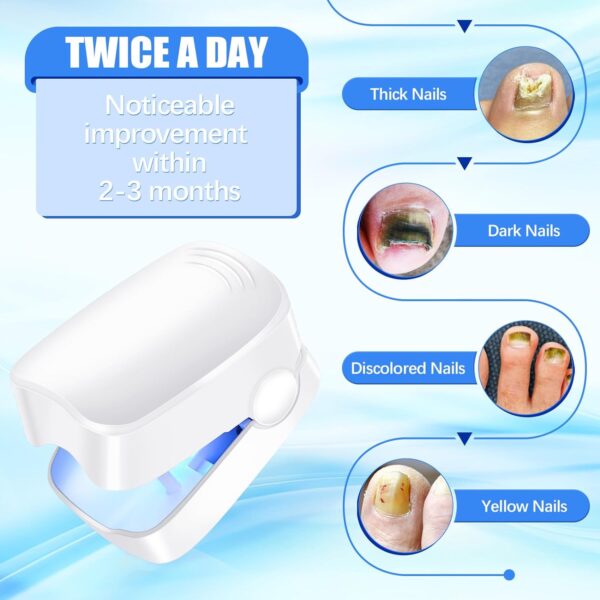 Rechargeable Nail Fungus Treatment for Toenail, Toe Nail Fungal Treatment Nail Fungus Laser Device, Anti-Fungal Nail Treatment for Hand & Feet Infections Remover for Home Use - Image 7